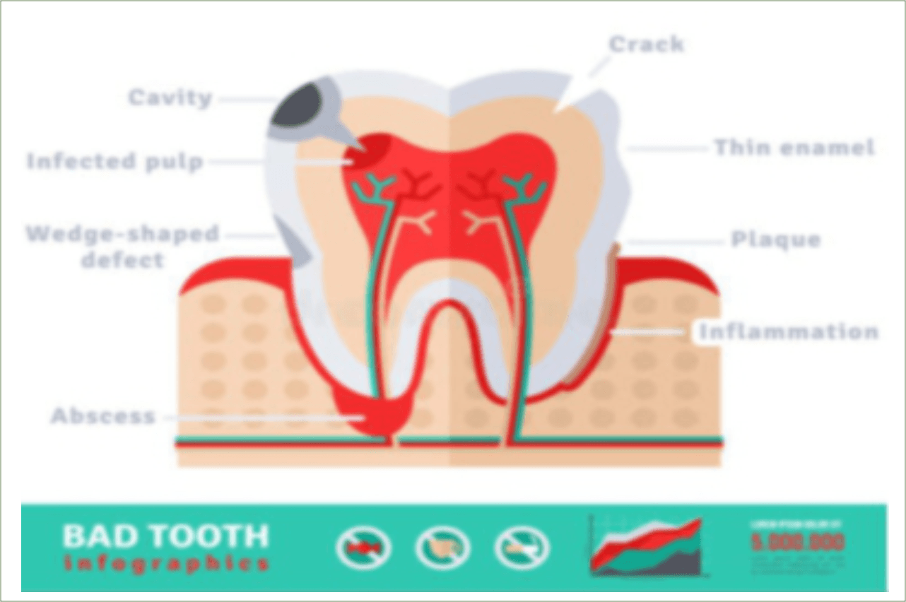 CBD and Toothaches: Is It Better Than Traditional Painkillers