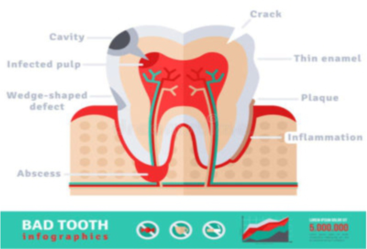 abscessed tooth, CBD and Toothaches