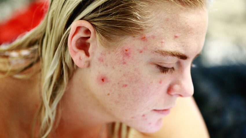 Woman, severe acne, skin, scar tissue