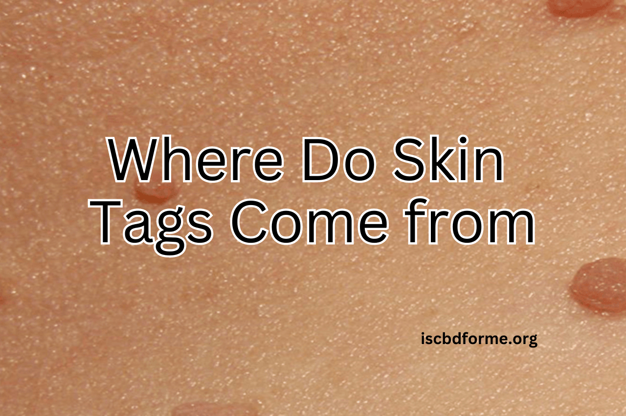 Surprising Facts About Skin Tags You Need To Know