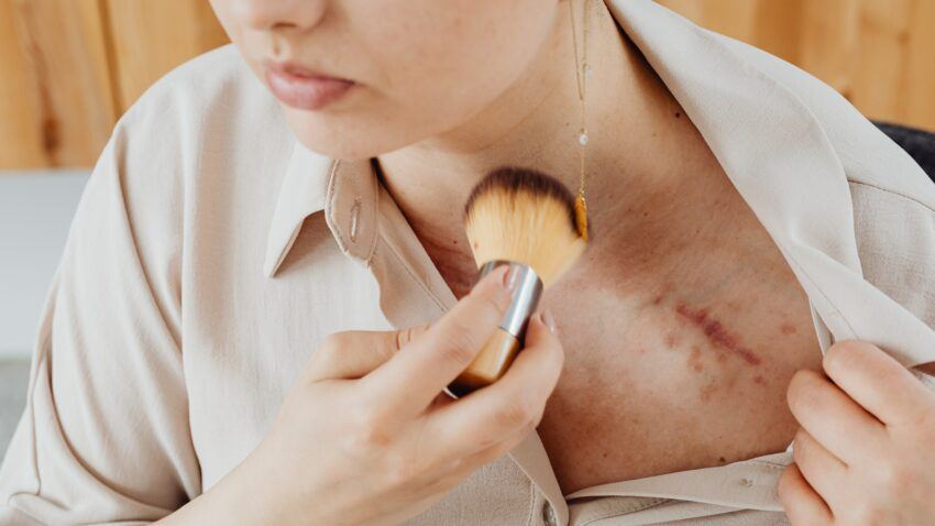 Woman, scar on neck, scar tissue